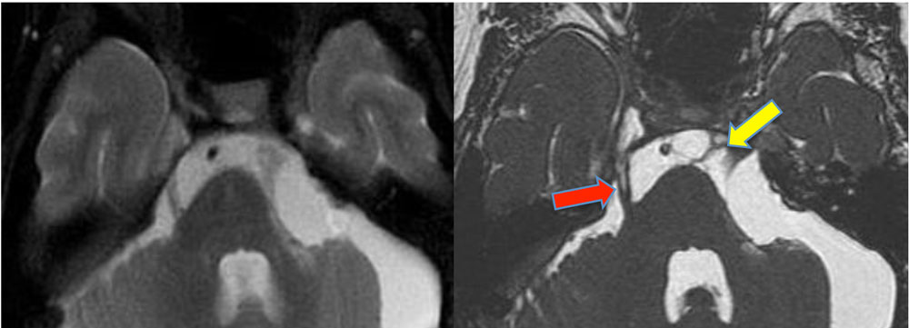 Partial Volume Effects Questions And Answers In MRI