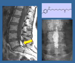 MRI pantopaque